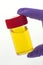 Urine specimen - Medical analysis