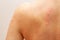 Urticaria allergy on skin back, close up