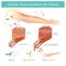 Urticaria, Hives and Allergic Skin Rashes. Illustration.