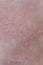 Urticaria on the skin. Red spots of an allergic reaction on the skin of a child. Urticaria symptoms close up