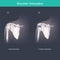 This is use for explain and compare when the head of the humerus is out of the shoulder joint include shoulder pain. Anatomy body