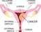 Uterine Cancer Vector Poster or Chart with Cancerous Tumor Cells on Endometrium Tissue of Uterus