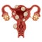 Uterine Fibroid