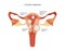 Uterine fibroid