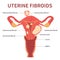 Uterine fibroids close-up view on white background