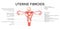 Uterine fibroids Female leiomyomas reproductive system uterus diagram with inscriptions in Latin text. Human anatomy