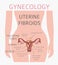 Uterine fibroids. Ginecological medical desease in women infographic