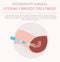 Uterine fibroids. Ginecological medical desease in women infographic