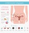 Uterine fibroids. Ginecological medical desease in women infographic