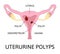 Uterine polyps. Human realistic uterus. Anatomy illustration