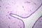 Uterus adenofibroma, light micrograph