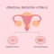 Uterus and cervical erosion