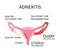 Uterus and ovaries scheme, adnexitis - infection and inflammation in the fallopian tube and ovary. Uterus inflammation