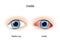 Uveitis. inflammation eye