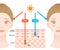 Uvinfographic illustration of difference between UVA and UVB rays. UV penetration into human skin and woman face. skin care and be