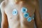 Valencia, Spain - July 17, 2019: Electrodes placed on the chest of a child to perform an electrocardiogram in a hospital