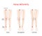 Valgus deformities. healthy joint, knock-knee and Bow-leggedness