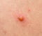 Varicella zoster virus or Chickenpox bubble rash on child