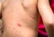 Varicella zoster virus or Chickenpox bubble rash on child, baby