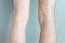 Varicose and spider veins on legs