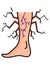 Varicose treatment icon. Violation of circulatory system. Vascular disease diagnostic. Venous insufficiency medical