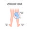 Varicose vein and normal vein