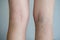 Varicose veins