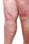 The varicose veins