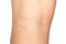 Varicose veins on the back of the knee of a young caucasian woman