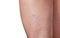 Varicose veins and capillary veins in the legs.