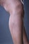 Varicose veins closeup, thick female legs