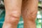 Varicose veins on knee and leg in senior woman, Burred blue swimming pool background, Close up, Asian Body skin, Healthcare