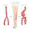 Varicose veins, large, swollen vein on the legs and feet. Medical schematic