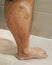 Varicose veins in the leg.