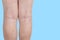 The varicose veins on a legs of woman