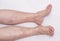 Varicose veins in the legs of a woman, white background, varicose veins on the calves of the legs and lower legs, phlebeurysm