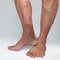 Varicose veins of the lower extremities