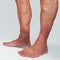 Varicose veins of the lower extremities