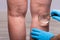 Varicose Veins On Man`s Leg Through Magnifying Glass
