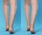 Before and after varicose veins treatment. Collage with photos of woman showing legs on light blue background, closeup