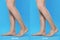 Before and after varicose veins treatment. Collage with photos of woman showing legs on light blue background, closeup