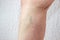 Varicose veins on a woman leg, a node under the knee