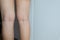 Varicose veins on the woman leg,Normal veins near the skin layer swell out,And blood is accumulated to see a bloody blue or dark