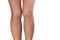 Varicose veins of woman legs