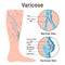 Varicoses. Anatomical diagram of varicose vein and normal healthy vein