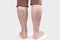 Varicosity. Close up view of old legs of woman with vascular asterisks. Back view. White background. The concept of