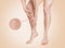 Varicosity. A woman grabs a sore leg with diseased blood vessels. Zoomed image of vessels in a circle. Close up. Beige background