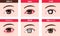 Various eye diseases vector illustration  female eye