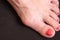 Varus valgus and Hallux valgus or bunion on middle aged woman foot. Isolated closeup on dark background. Concept of treatment or