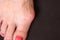 Varus valgus and Hallux valgus or bunion on middle aged woman foot. Isolated closeup on dark background. Concept of treatment or